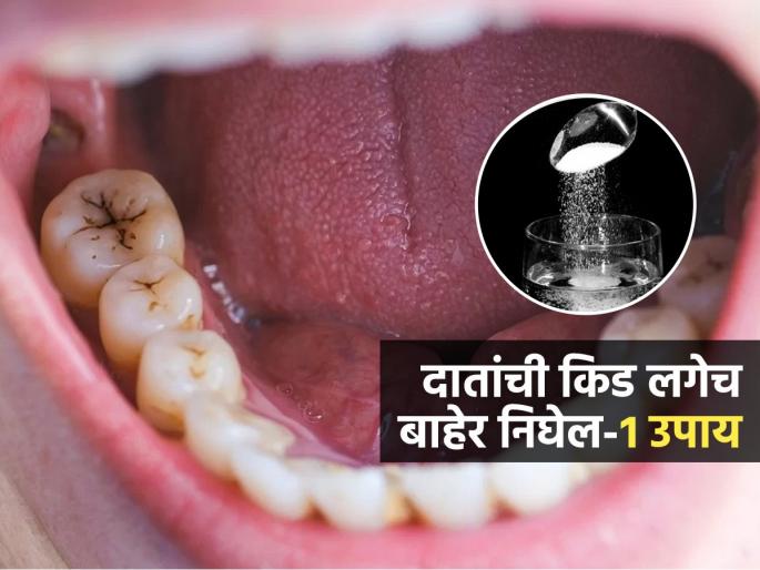 Famous Detist Dr Ellie Phillips Share 5 Effective Tips To Get Rid Of Cavity At Home | दातांना खालून खड्डे पडलेत-किड लागली? डॉक्टर सांगतात १ खास उपाय, अलगद किड निघेल बाहेर