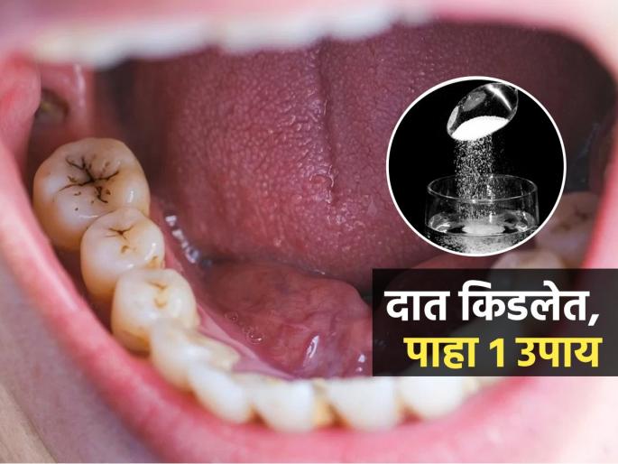 Famous Detist Dr Ellie Phillips Share 5 Effective Tips To Get Rid Of Cavity At Home | Tips To Get Rid Of Cavity : दातांना आतून खड्डे पडलेत-कीड लागली? डॉक्टर सांगतात १ खास उपाय, दातदुखी होते कमी