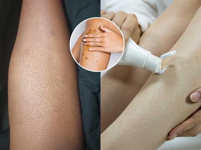 Removing leg hair with a razor gives you strange strawberry legs, see what to do | रेझरने पायावरचे केस काढल्याने स्ट्रॉबेरी लेग्ज दिसतात विचित्र, पाहा पायांवर खड्डे पाडणारा हा कोणता त्रास Removing leg hair with a razor gives you strange strawberry legs, see what to do | रेझरने पायावरचे केस काढल्याने स्ट्रॉबेरी लेग्ज दिसतात विचित्र, पाहा पायांवर खड्डे पाडणारा हा कोणता त्रास