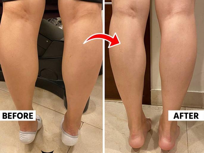 calf fat can be danger, risk of serious diseases, try some easy remedies and stay fit and healthy | पोटऱ्या मऊ-थुलथुलीत दिसतात? पोटऱ्यांवरची चरबी म्हणजे गंभीर आजारांचा धोका,पोटऱ्या म्हणजे दुसरे हृदय calf fat can be danger, risk of serious diseases, try some easy remedies and stay fit and healthy | पोटऱ्या मऊ-थुलथुलीत दिसतात? पोटऱ्यांवरची चरबी म्हणजे गंभीर आजारांचा धोका,पोटऱ्या म्हणजे दुसरे हृदय