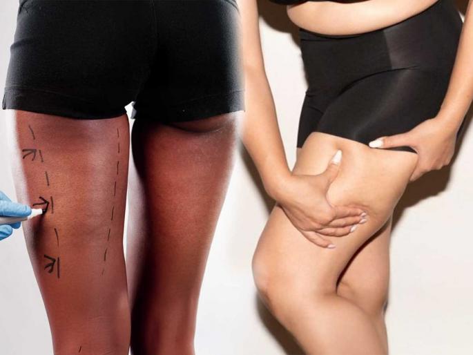 Thighs turned black, red and ugly? Know the reasons and do simple home remedies | मांड्या काळ्या - लालसर आणि कुरुप झाल्या ? जाणून घ्या कारणे आणि करा सोपे घरगुती उपाय Thighs turned black, red and ugly? Know the reasons and do simple home remedies | मांड्या काळ्या - लालसर आणि कुरुप झाल्या ? जाणून घ्या कारणे आणि करा सोपे घरगुती उपाय