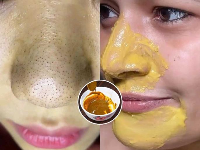 Blackheads Removal Tips : Easy Ways To Remove Blackheads And Whiteheads From Nose | नाकावर बारीक दाणे येतात? किचनमधला हा पदार्थ आठवड्यातून एकदा लावा, ब्लॅकहेड्स गायब
