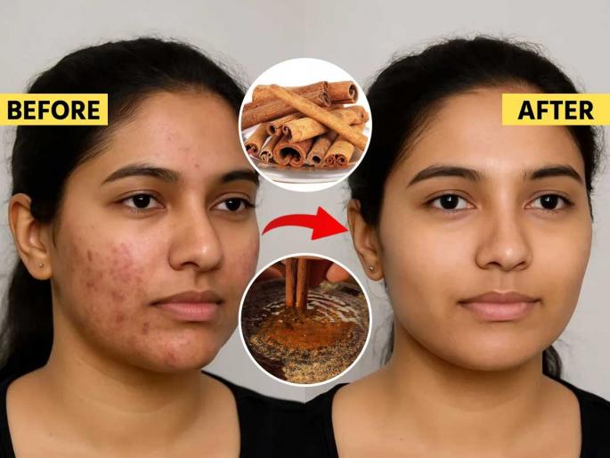 3 home hacks to get rid of acne and breakouts on skin, how to reduce acne and breakouts on skin, home remedies to get acne free skin | ब्रेकआऊट्स- ॲक्ने वाढल्याने तरुणीपणीच म्हातारे दिसताय? ३ सोपे घरगुती उपाय, तारुण्य येईल परत 3 home hacks to get rid of acne and breakouts on skin, how to reduce acne and breakouts on skin, home remedies to get acne free skin | ब्रेकआऊट्स- ॲक्ने वाढल्याने तरुणीपणीच म्हातारे दिसताय? ३ सोपे घरगुती उपाय, तारुण्य येईल परत