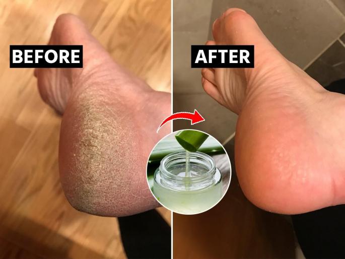 how to get rid of cracked heel, simple home remedies for soft feet, home hacks for cracked heel | उष्णतेमुळे भेगाळलेल्या तळपायांना 'या' पद्धतीने लावा कोरफड, भेगा भरतील- तळपाय होतील मऊ how to get rid of cracked heel, simple home remedies for soft feet, home hacks for cracked heel | उष्णतेमुळे भेगाळलेल्या तळपायांना 'या' पद्धतीने लावा कोरफड, भेगा भरतील- तळपाय होतील मऊ