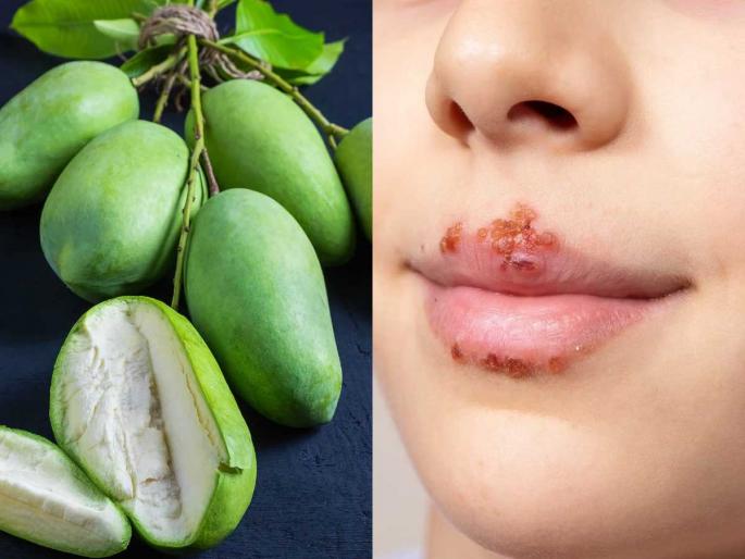 Did Kairi's scream cause a wound near lips? 3 solutions - The pain will stop and you will feel better soon | कैरीचा चीक उभारल्याने ओठांजवळ जखम झाली? ३ उपाय- आग थांबून लवकर बरं वाटेल Did Kairi's scream cause a wound near lips? 3 solutions - The pain will stop and you will feel better soon | कैरीचा चीक उभारल्याने ओठांजवळ जखम झाली? ३ उपाय- आग थांबून लवकर बरं वाटेल