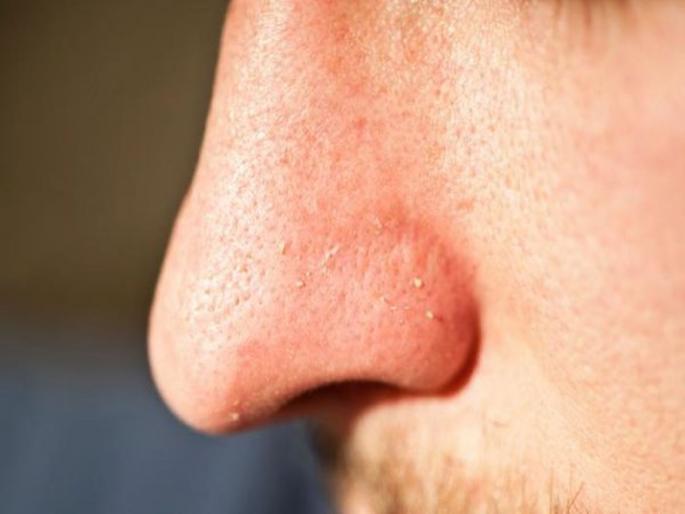 How to get rid of whiteheads at home | व्हाइड हेड्स दूर करायचे आहेत?; 'हे' 5 घरगुती उपाय ट्राय करा How to get rid of whiteheads at home | व्हाइड हेड्स दूर करायचे आहेत?; 'हे' 5 घरगुती उपाय ट्राय करा