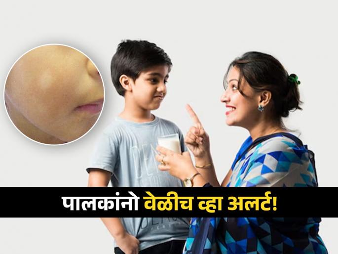 1 mistake of parents cause white spots on kids face doctor warns | बापरे! आई-वडिलांच्या एका छोट्याशा चुकीचा मुलांना त्रास, चेहऱ्यावर पडतात पांढरे डाग