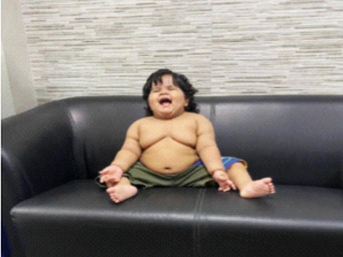 MUMBAI: Ibrahim came down from kilos to grams after the surgery, the monthly weight gain stopped | Mumbai: इब्राहिम शस्त्रक्रियेनंतर किलोवरून आला ग्रॅमवर, महिन्याला होणारी वजनवाढ थांबली MUMBAI: Ibrahim came down from kilos to grams after the surgery, the monthly weight gain stopped | Mumbai: इब्राहिम शस्त्रक्रियेनंतर किलोवरून आला ग्रॅमवर, महिन्याला होणारी वजनवाढ थांबली