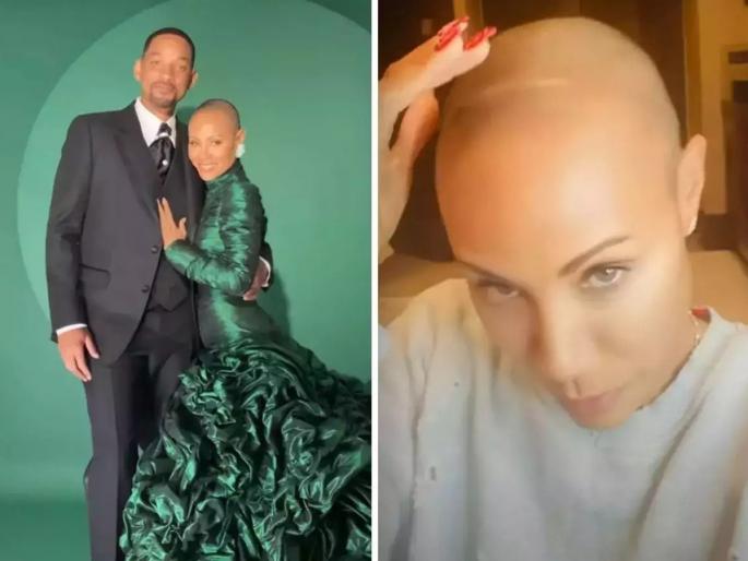 What is Alopecia Areata; condition Will Smith’s wife Jada Smith is suffering from | विल स्मिथची पत्नी जेडा स्मिथ हिला नेमका कोणता आजार आहे? ऑस्करमधील घटनेमुळे चर्चेत What is Alopecia Areata; condition Will Smith’s wife Jada Smith is suffering from | विल स्मिथची पत्नी जेडा स्मिथ हिला नेमका कोणता आजार आहे? ऑस्करमधील घटनेमुळे चर्चेत