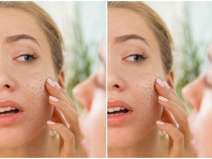 Winter has come, take care of the skin; Complaints of dry, rough, discolored skin increased | आला हिवाळा, त्वचा सांभाळा; त्वचा कोरडी, रखरखीत, रंगहीन पडण्याच्या तक्रारी वाढल्या