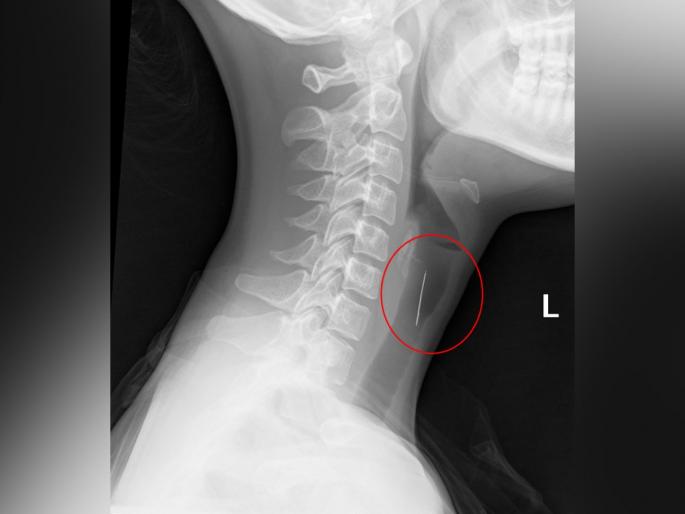Australia woman hospitalised after needle found in strawberry | स्ट्रॉबेरी खाणं महिलेला असं पडलं महागात; एक्स-रे पाहून डॉक्टरही हैराण Australia woman hospitalised after needle found in strawberry | स्ट्रॉबेरी खाणं महिलेला असं पडलं महागात; एक्स-रे पाहून डॉक्टरही हैराण