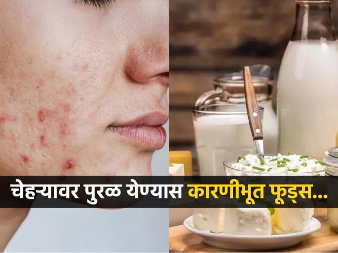According to doctor worst food for skin avoid sugar and milk for glowing skin | चेहऱ्यावर नेहमीच पुरळ, सुरकुत्या येण्यासाठी कारणीभूत फूड्स, डॉक्टरांनी सांगितली लिस्ट...