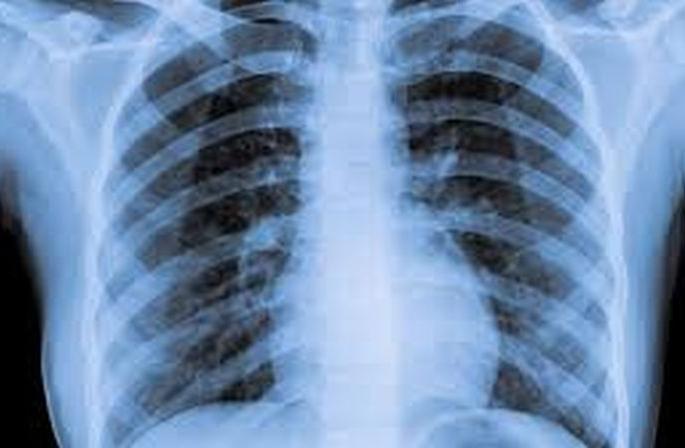 X-ray of corona suspects in Malkapur | मलकापूरमध्ये संदिग्धांचे एक्सरे काढण्याच्या हालचाली X-ray of corona suspects in Malkapur | मलकापूरमध्ये संदिग्धांचे एक्सरे काढण्याच्या हालचाली