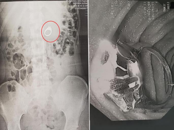 California woman swallowed engagement ring in dream find actually did | चोरांपासून वाचवण्यासाठी स्वप्नातच गिळली अंगठी; सकाळी उठून पाहते तर... California woman swallowed engagement ring in dream find actually did | चोरांपासून वाचवण्यासाठी स्वप्नातच गिळली अंगठी; सकाळी उठून पाहते तर...
