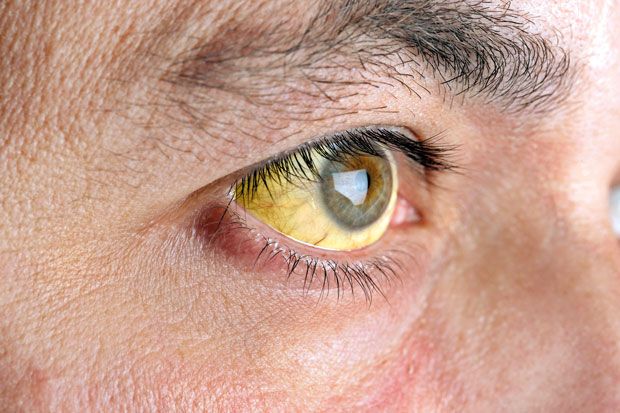 Know what is yellow fever why it is necessary to vaccinate it before going abroad | काय आहे यल्लो फिवर?; जाणून घ्या काय आहेत लक्षणं... Know what is yellow fever why it is necessary to vaccinate it before going abroad | काय आहे यल्लो फिवर?; जाणून घ्या काय आहेत लक्षणं...