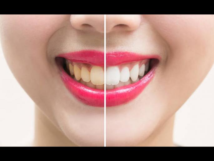 Ayurveda doctor told recipe of teeth whitening powder at home to make your yellow teeth white | डेंटिस्टला द्यावे लागणार नाही 2 हजार रूपये, या आयुर्वेदिक पावडरने घरीच दूर करा दातांचा पिवळेपणा Ayurveda doctor told recipe of teeth whitening powder at home to make your yellow teeth white | डेंटिस्टला द्यावे लागणार नाही 2 हजार रूपये, या आयुर्वेदिक पावडरने घरीच दूर करा दातांचा पिवळेपणा