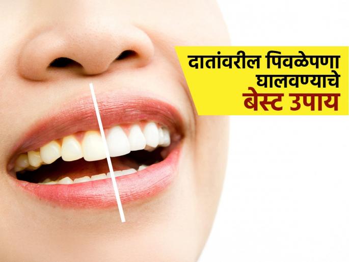 How to get rid of yellow teeth top 3 home remedies for yellow teeth | दातांचा पिवळेपणा दूर करणारे ३ घरगुती उपाय, चारचौघात हसताना लाजू नका-हसा मनमोकळं..