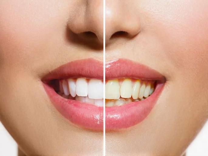 home remedies to whiten your yellow teeth. do these remedies before sleeping in night and your teeth will be white and clean | रात्री झोपण्यापूर्वी 'ही' कामे केल्यास दातांचा पिवळेपणा होईल चटकन दूर, दात होतील पांढरेशुभ्र