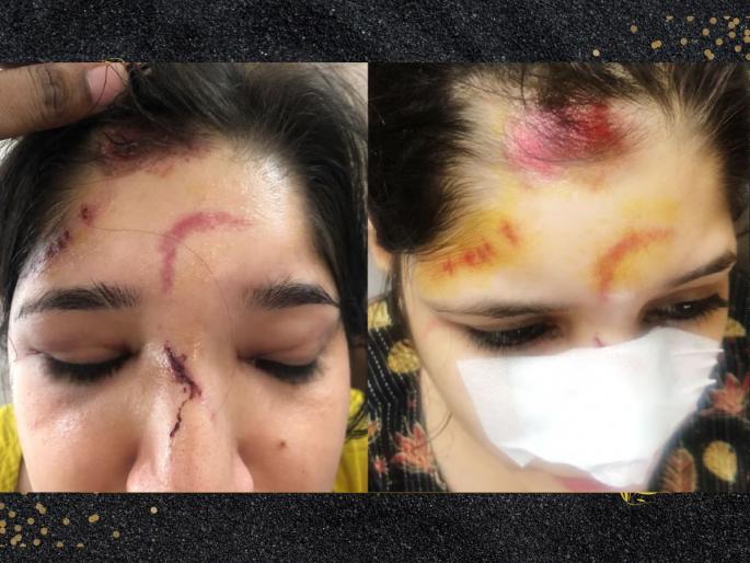 delhi women teacher falls out of auto dragged on road and snatched iphone | आयफोन हिसकावण्यासाठी ऑटोमधल्या महिलेवर स्नॅचरने केला हल्ला; फरफटत नेलं, नाक तुटलं