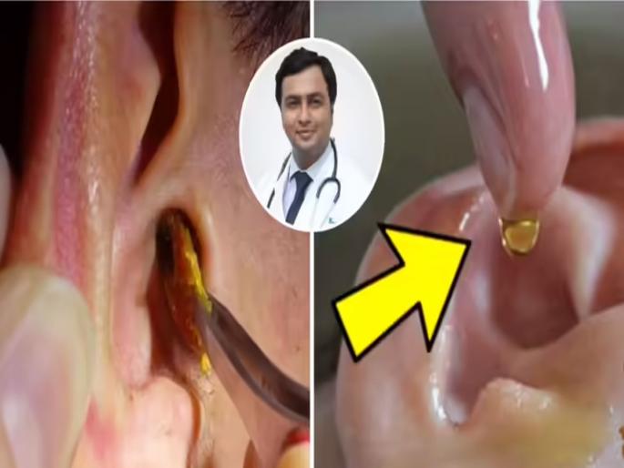 3 Easy Ways To Remove Shares Ear Wax Senior Ent Surgeon At Apollo Hospital Dr. Naseeruddin | १० सेकंदात निघेल कानातला मळ; डॉक्टर सांगतात 3 उपाय, मळ निघेल-ऐकूही नीट येईल