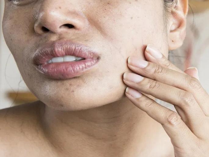 How to remove monkey patches on the skin | ओठाच्या आजूबाजूच्या मंकी पॅचेसमुळे चेहरा खराब दिसतो? घरच्याघरी 'या' उपायांनी मंकी पॅचेस होतील दूर How to remove monkey patches on the skin | ओठाच्या आजूबाजूच्या मंकी पॅचेसमुळे चेहरा खराब दिसतो? घरच्याघरी 'या' उपायांनी मंकी पॅचेस होतील दूर