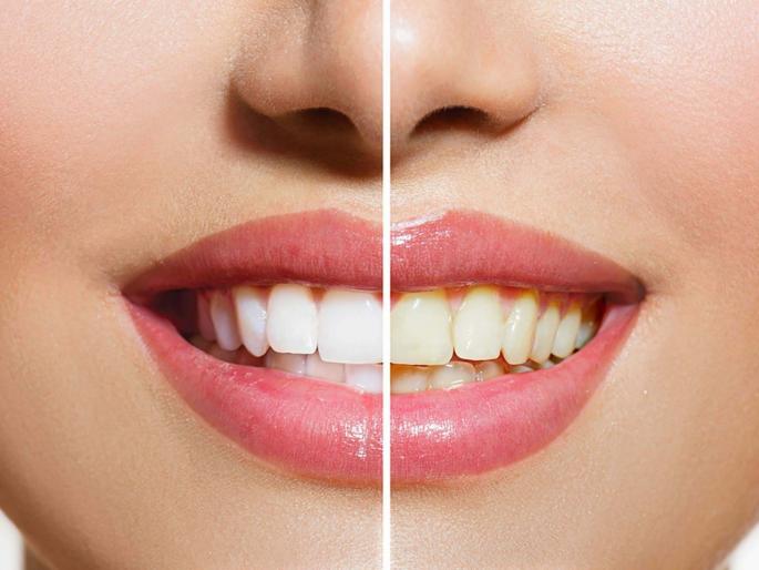 Know the home remedies can help you to whiten your teeth | महागड्या टुथपेस्टमुळे नाही तर 'या' ५ गोष्टींमुळे दात होतील चमकदार Know the home remedies can help you to whiten your teeth | महागड्या टुथपेस्टमुळे नाही तर 'या' ५ गोष्टींमुळे दात होतील चमकदार