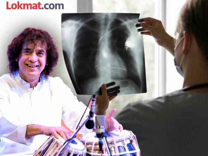 Ustad Zakir Hussain died caused by disease called Idiopathic Pulmonary Fibrosis | उस्ताद झाकीर हुसैन यांच्या मृत्यूसाठी 'हा' आजार ठरला; जाणून घ्या Ustad Zakir Hussain died caused by disease called Idiopathic Pulmonary Fibrosis | उस्ताद झाकीर हुसैन यांच्या मृत्यूसाठी 'हा' आजार ठरला; जाणून घ्या