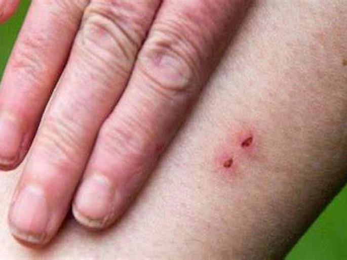 Bitten by a poisonous snake in his sleep, MR fights to the death | विषारी सापाचा झोपेत दंश, एमआरची मृत्यूशी झुंज Bitten by a poisonous snake in his sleep, MR fights to the death | विषारी सापाचा झोपेत दंश, एमआरची मृत्यूशी झुंज