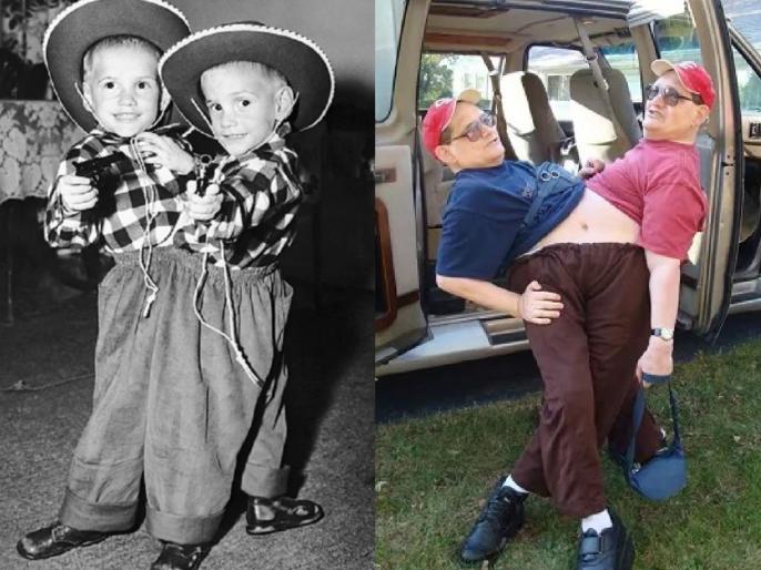 SEE PICS! World's Longest-surviving Conjoined Twins Die Together At The ...