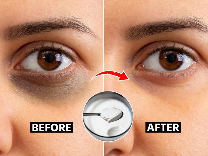 Under Eye Bags Causes Symptoms Home Remedies and Treatment
