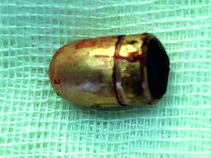 Bullet fixes in jaw removed successfully by Nagpur Govt.Dental Hospital | बापरे! डॉक्टरांनी जबड्यातून काढली बंदुकीची गोळी; नागपुरात यशस्वी शस्त्रक्रिया