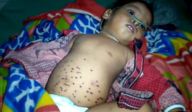 Cruel treatment to Sick child in Melghat | मेळघाटात आजारी बालकाच्या पोटावर गरम विळ्याचे 'डंबे'