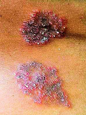Rapid growth of vitiligo patients | त्वचारोगाच्या रुग्णांमध्ये झपाट्याने वाढ