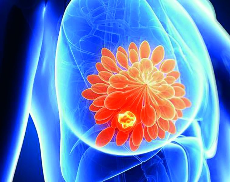 Breast Cancer Awareness Month; How Will Be An Effective Treatment? | स्तन कर्करोग जनजागृती महिना; कसा होईल प्रभावी उपचार?
