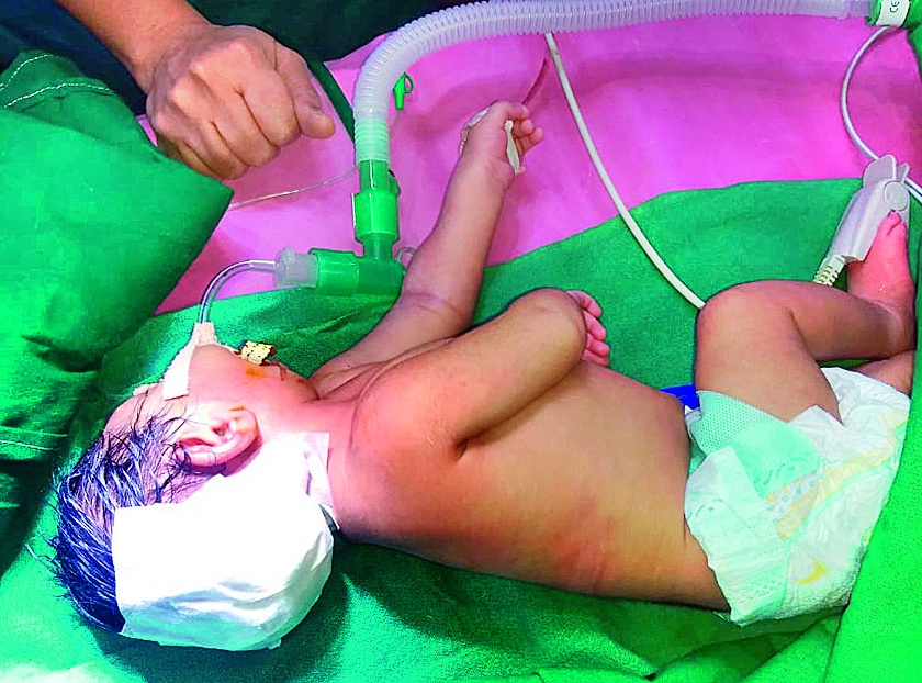 Successful surgery on one day's baby | एक दिवसाच्या बाळावर यशस्वी शस्त्रक्रिया, मेंदूशी संबंधित शस्त्रक्रियेने वाचवले बाळ