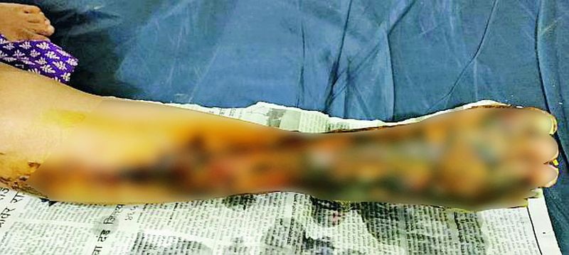 The hospital heater burned the pregnant woman's leg, cutting off her fingers | रुग्णालयातील हिटरने गर्भवतीचा पाय भाजला, बोटे कापली