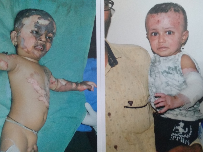 Sangli's Skin Bank Lives Two Children | सांगलीच्या स्किन बँकेमुळे दोन बालकांना जीवदान