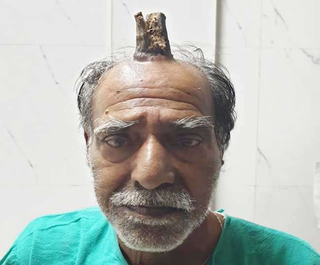 Shocking...! horn grown on head of 74 year old man in madhya pradesh | डोके आदळू नका, शिंग उगवेल....अरेच्चा खरेच उगवले की!