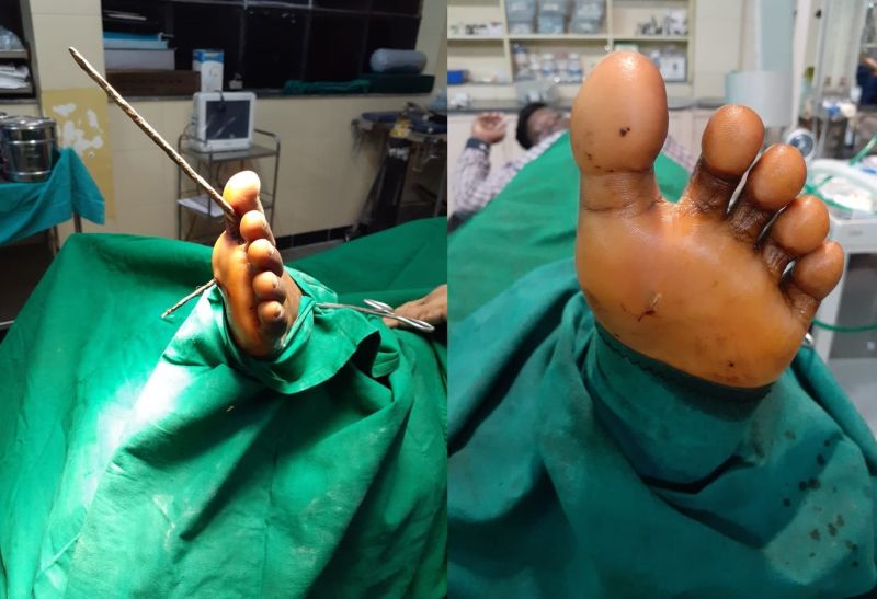 Successfully removed iron rod inserted into the foot; Incidents in Wardha district | पायात घुसलेली लोखंडी सळई यशस्वीरित्या काढली; वर्धा जिल्ह्यातील घटना