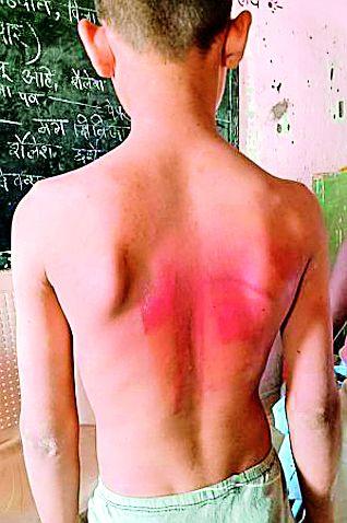 Adivasi student suffers beatly | आदिवासी विद्यार्थ्याला बेदम मारहाण