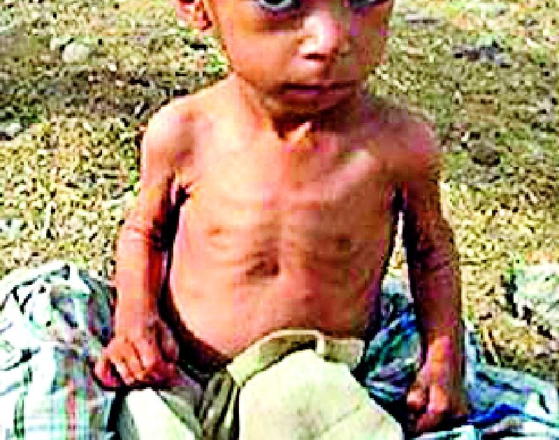 In the district 228 children are severely malnourished | जिल्ह्यात २२८ बालके तीव्र कुपोषित