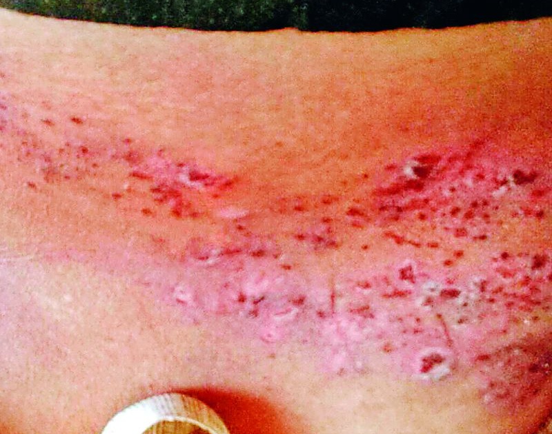 Due to vitiligo, the villages of the village suffer | त्वचारोगाने गावेच्या गावे बेजार