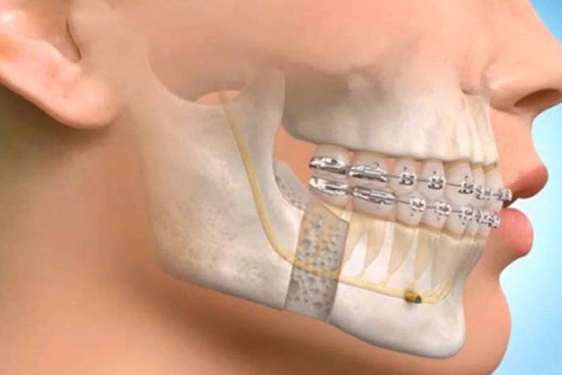 Reconstruction of the jaw after eleven hours of surgery | अकरा तासांच्या शस्त्रक्रियेनंतर जबड्याची पुनर्निर्मिती 