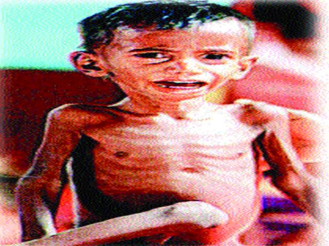 83 acute and moderately malnourished children | ८३ तीव्र तर २५० मध्यम कुपोषित बालके