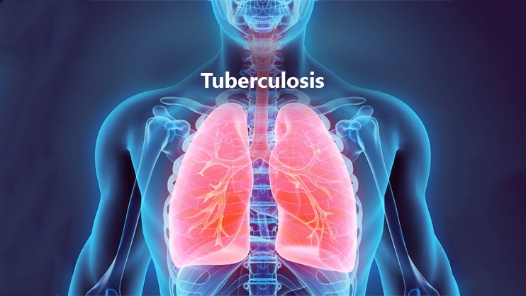 Tuberculosis is as deadly as corona, swine flu! | क्षय रोगाचा आजार कोरोना ,स्वाइन फ्ल्यू इतकाच घातक!