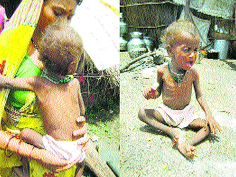 Over twelve thousand children are malnourished in the district | जिल्ह्यात बारा हजारांहून अधिक बालके कुपोषित