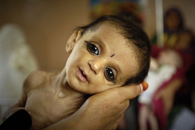 Increased number of severely malnourished children | तीव्र, अतितीव्र कुपोषणग्रस्त बालकांची वाढली संख्या