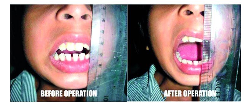 The first jaw joint made in India received a patent; It took 14 years to validate the research | भारतात तयार झालेल्या जबड्याच्या पहिल्या जॉईंटला मिळाले पेटंट; संशोधनाच्या मान्यतेस लागली १४ वर्षे 