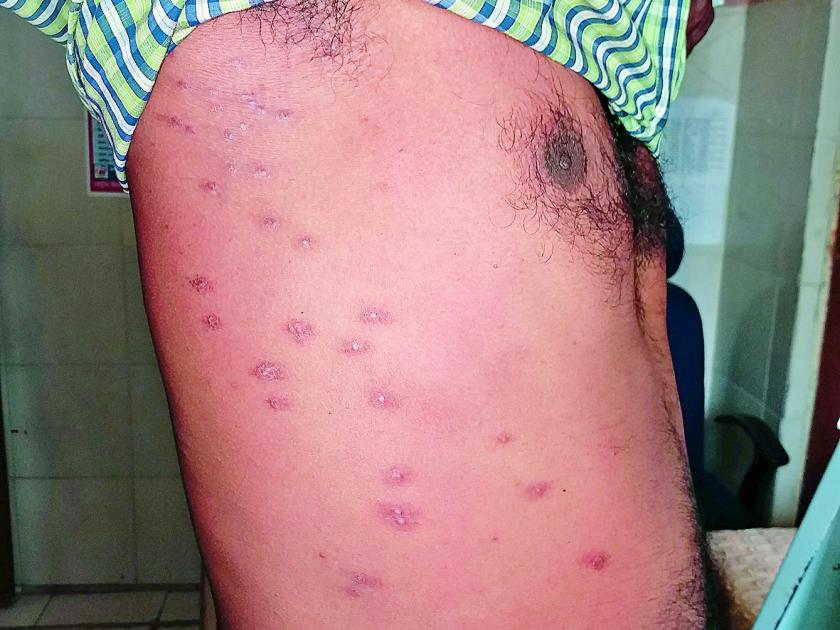 'Red bug' is dangerous for rural areas in Nagpur | नागपूर ग्रामीण भागात ‘रेड बग’ ठरतोय धोकादायक