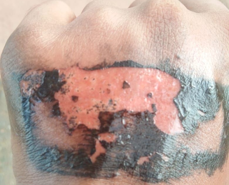 Burnt hand skin due to ‘Home Quarantine’ stamp | ‘होम क्वॉरंटाईन’चा शिक्का मारल्याने भाजली हाताची त्वचा